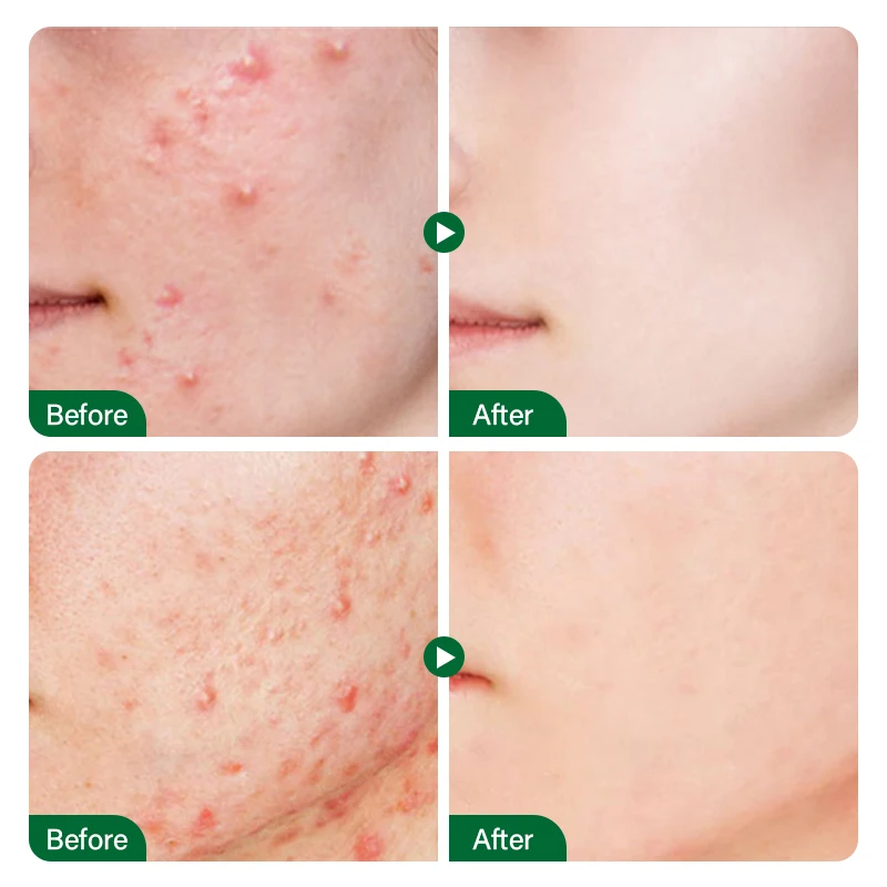 FORT Salicylic Acid Serum – Anti-Acne Face Serum & Dark Spot Correcting Serum for Glowing Skin | Acne Skin Care Products 30ml