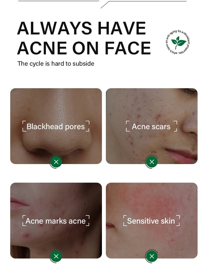FORT Salicylic Acid Serum – Anti-Acne Face Serum & Dark Spot Correcting Serum for Glowing Skin | Acne Skin Care Products 30ml